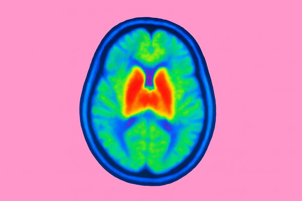 PET scan showing neuroinflammation in the human brain